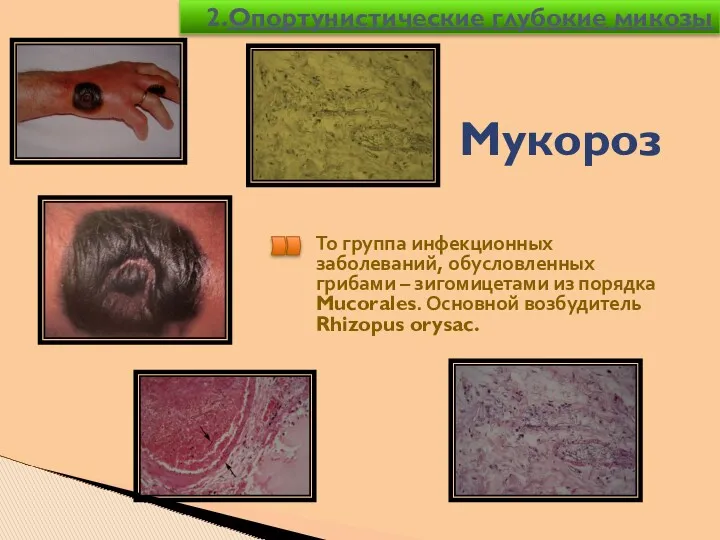 Мукороз То группа инфекционных заболеваний, обусловленных грибами – зигомицетами из порядка Mucorales. Основной