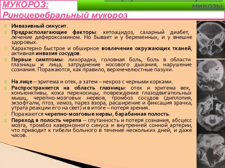 Инвазивный синусит. Предрасполагающие факторы: кетоацидоз, сахарный диабет, лечение дефероксамином. Но