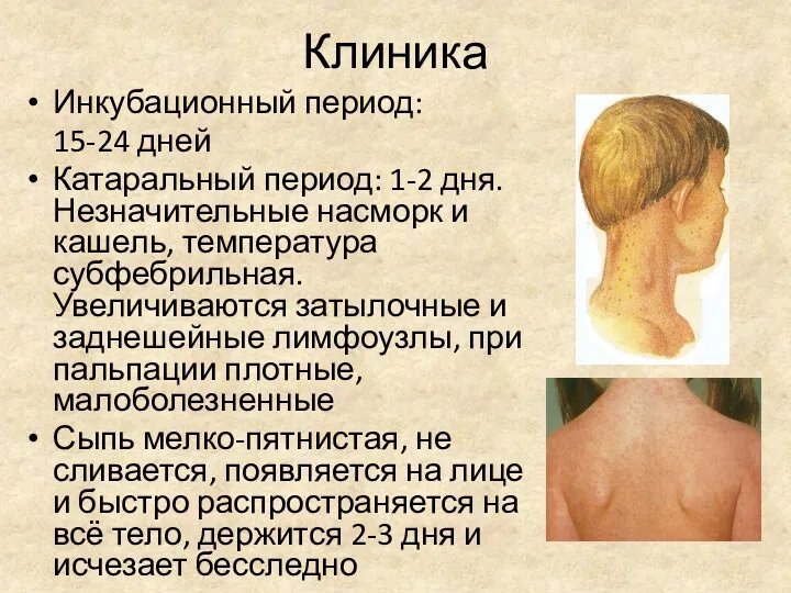 Клиника Инкубационный период: 15-24 дней Катаральный период: 1-2 дня. Незначительные