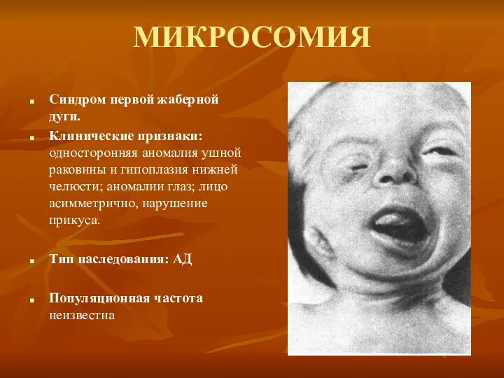 МИКРОСОМИЯ Синдром первой жаберной дуги. Клинические признаки: односторонняя аномалия ушной