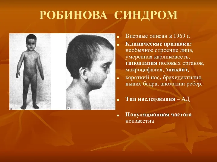 РОБИНОВА СИНДРОМ Впервые описан в 1969 г. Клинические признаки: необычное