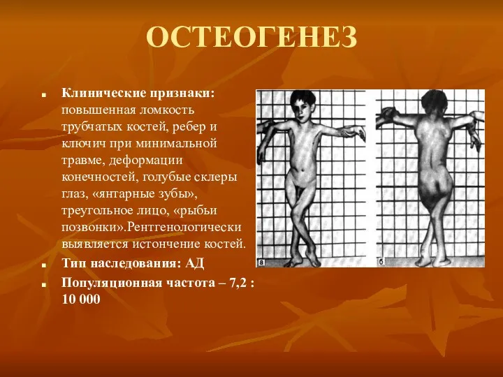 ОСТЕОГЕНЕЗ Клинические признаки: повышенная ломкость трубчатых костей, ребер и ключич