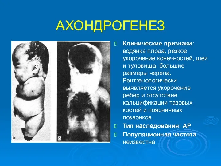 АХОНДРОГЕНЕЗ Клинические признаки: водянка плода, резкое укорочение конечностей, шеи и