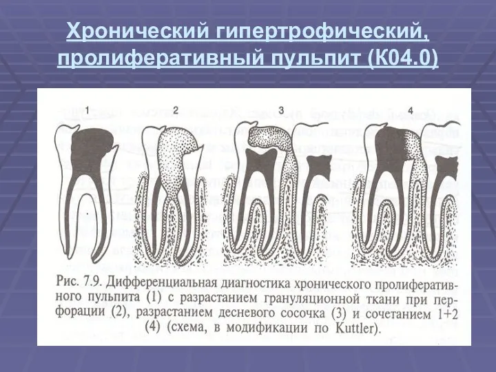 Хронический гипертрофический, пролиферативный пульпит (К04.0)