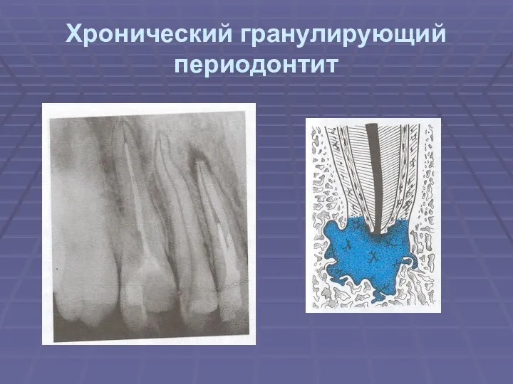 Хронический гранулирующий периодонтит