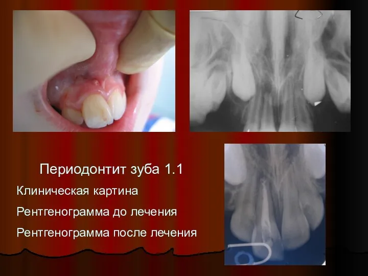 Периодонтит зуба 1.1 Клиническая картина Рентгенограмма до лечения Рентгенограмма после лечения