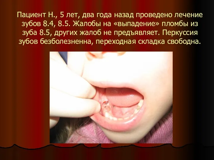 Пациент Н., 5 лет, два года назад проведено лечение зубов 8.4, 8.5. Жалобы