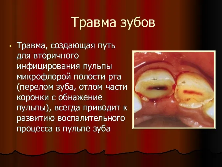 Травма зубов Травма, создающая путь для вторичного инфицирования пульпы микрофлорой полости рта (перелом