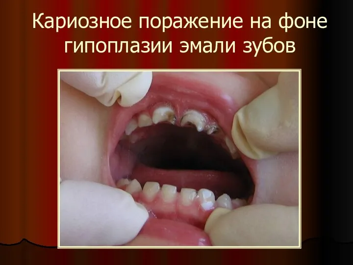 Кариозное поражение на фоне гипоплазии эмали зубов