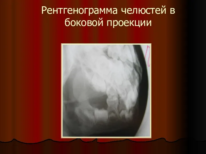 Рентгенограмма челюстей в боковой проекции