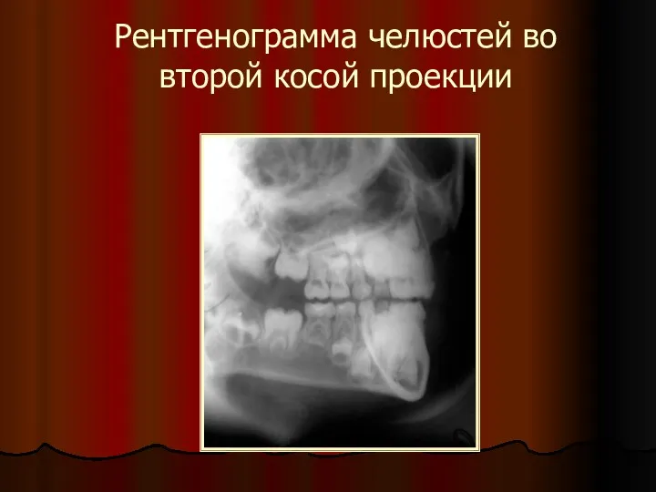 Рентгенограмма челюстей во второй косой проекции