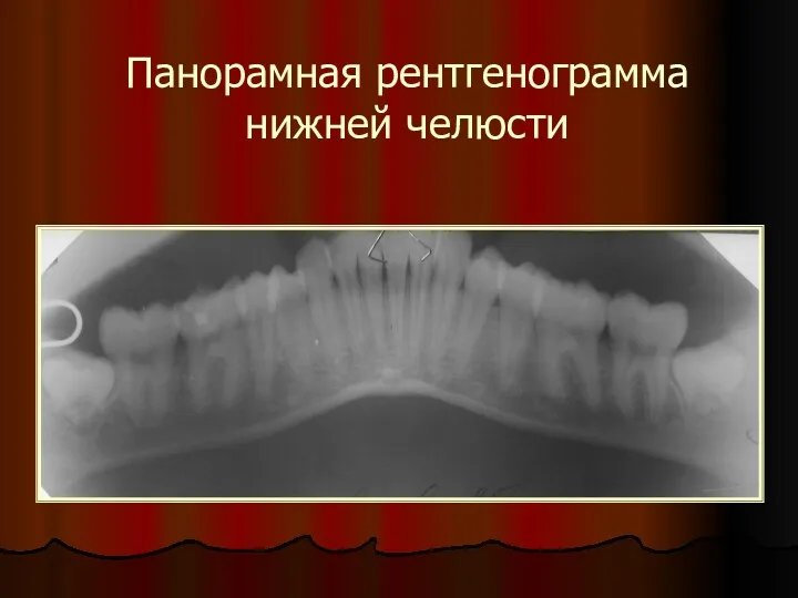 Панорамная рентгенограмма нижней челюсти