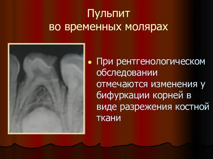 Пульпит во временных молярах При рентгенологическом обследовании отмечаются изменения у бифуркации корней в