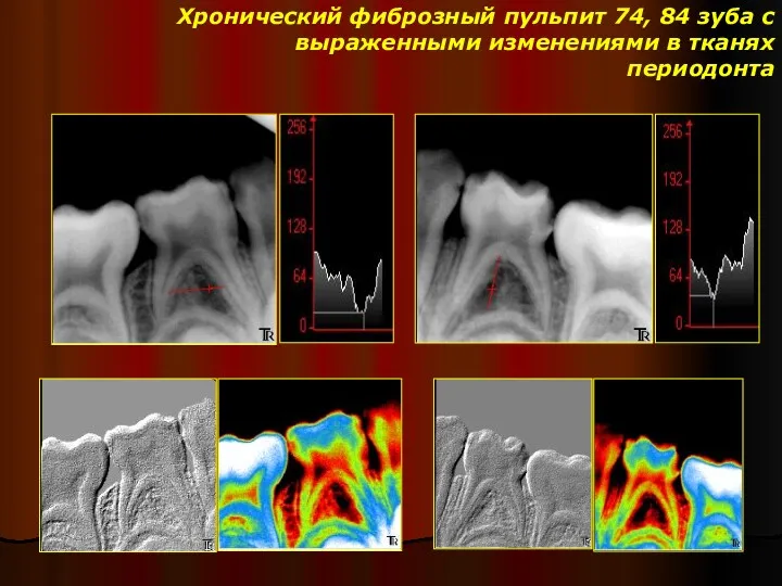Хронический фиброзный пульпит 74, 84 зуба с выраженными изменениями в тканях периодонта