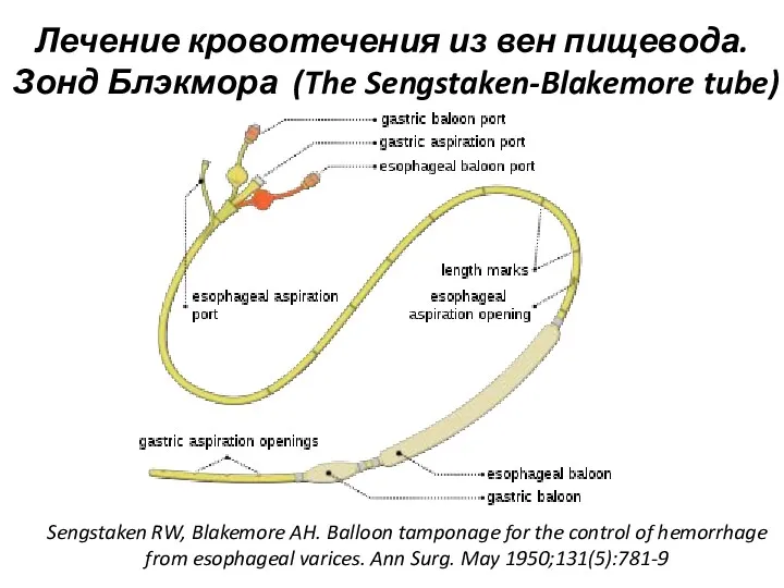 Лечение кровотечения из вен пищевода. Зонд Блэкмора (The Sengstaken-Blakemore tube)