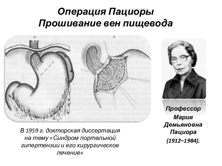 Операция Пациоры Прошивание вен пищевода Профессор Мария Демьяновна Пациора (1912–1984).