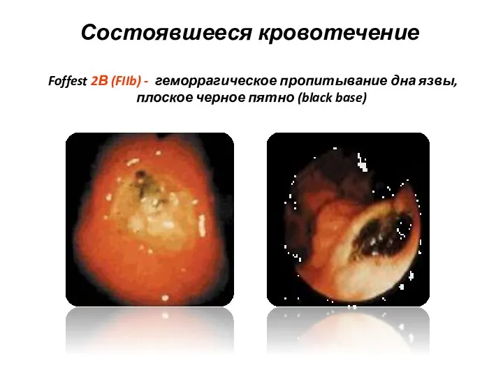 Состоявшееся кровотечение Foffest 2В (FIIb) - геморрагическое пропитывание дна язвы, плоское черное пятно (black base)