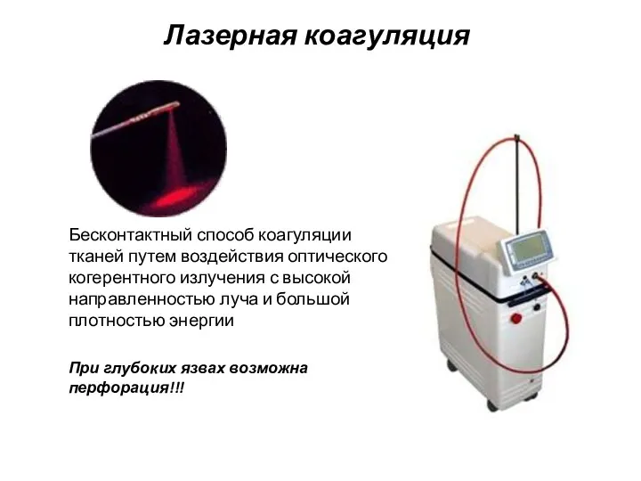 Лазерная коагуляция Бесконтактный способ коагуляции тканей путем воздействия оптического когерентного