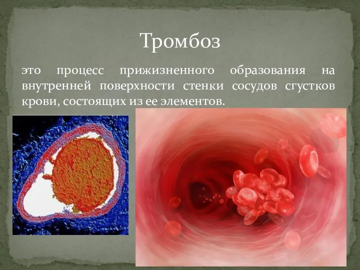 это процесс прижизненного образования на внутренней поверхности стенки сосудов сгустков крови, состоящих из ее элементов. Тромбоз