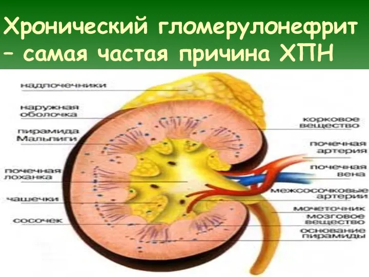 Хронический гломерулонефрит – самая частая причина ХПН