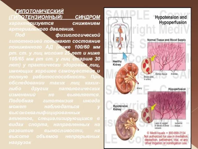 ГИПОТОНИЧЕСКИЙ (ГИПОТЕНЗИОННЫЙ) СИНДРОМ характеризуется снижением артериального давления. Под физиологической гипотензией