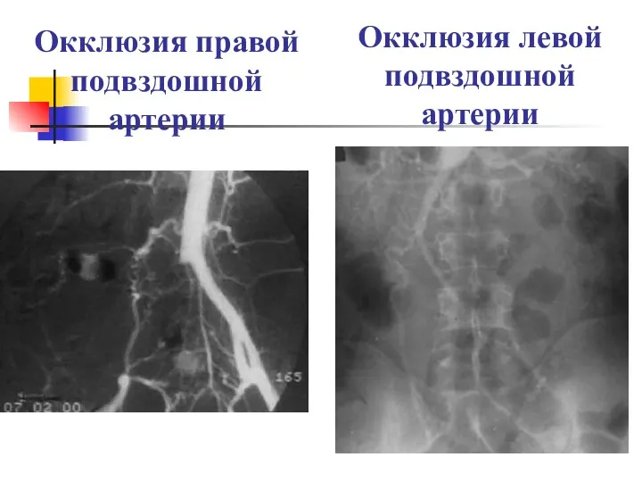 Окклюзия правой подвздошной артерии Окклюзия левой подвздошной артерии