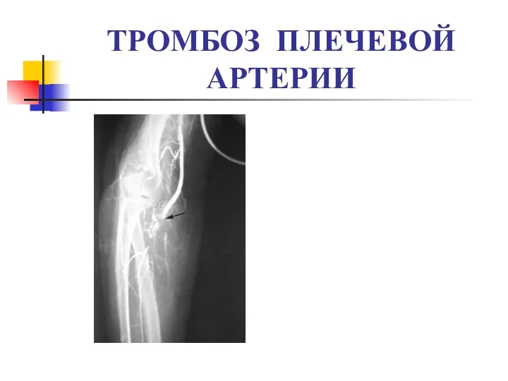 ТРОМБОЗ ПЛЕЧЕВОЙ АРТЕРИИ