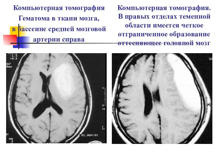 Компьютерная томография Гематома в ткани мозга, в бассеине средней мозговой