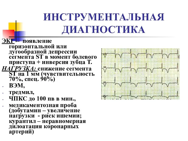 ИНСТРУМЕНТАЛЬНАЯ ДИАГНОСТИКА ЭКГ – появление горизонтальной или дугообразной депрессии сегмента