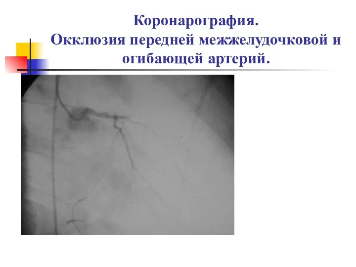 Коронарография. Окклюзия передней межжелудочковой и огибающей артерий.