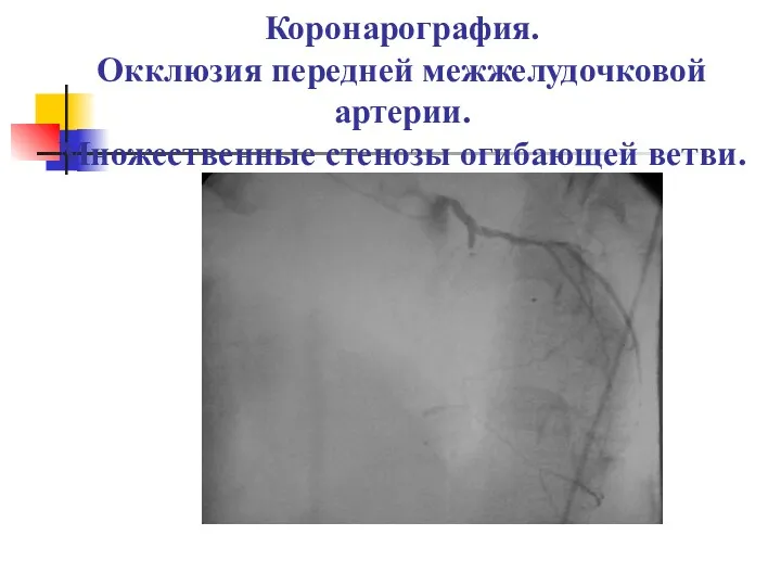Коронарография. Окклюзия передней межжелудочковой артерии. Множественные стенозы огибающей ветви.