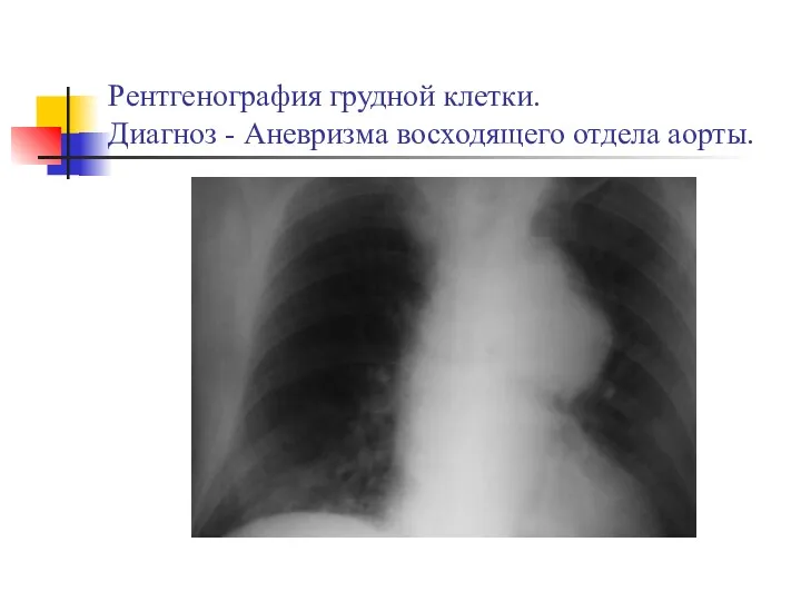 Рентгенография грудной клетки. Диагноз - Аневризма восходящего отдела аорты.