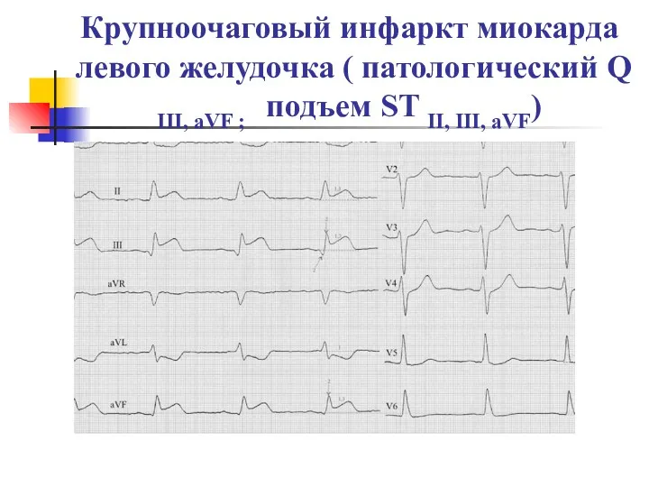 Крупноочаговый инфаркт миокарда левого желудочка ( патологический Q III, aVF ; подъем ST II, III, aVF)