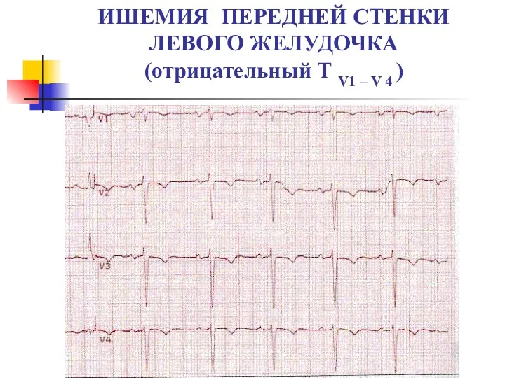 ИШЕМИЯ ПЕРЕДНЕЙ СТЕНКИ ЛЕВОГО ЖЕЛУДОЧКА (отрицательный Т V1 – V 4 )