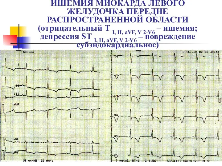 ИШЕМИЯ МИОКАРДА ЛЕВОГО ЖЕЛУДОЧКА ПЕРЕДНЕ РАСПРОСТРАНЕННОЙ ОБЛАСТИ (отрицательный T I,