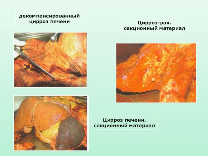 декомпенсированный цирроз печени Цирроз печени. секционный материал Цирроз-рак. секционный материал