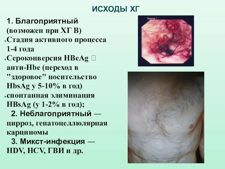 ИСХОДЫ ХГ 1. Благоприятный (возможен при ХГ В) Стадия активного