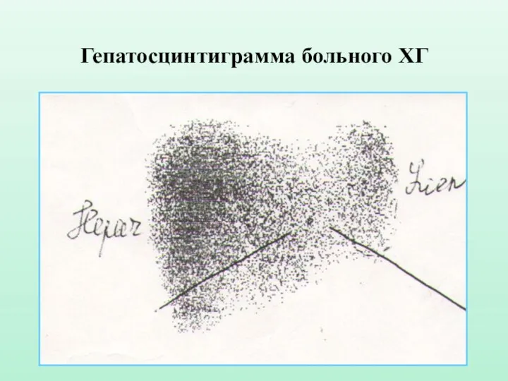 Гепатосцинтиграмма больного ХГ