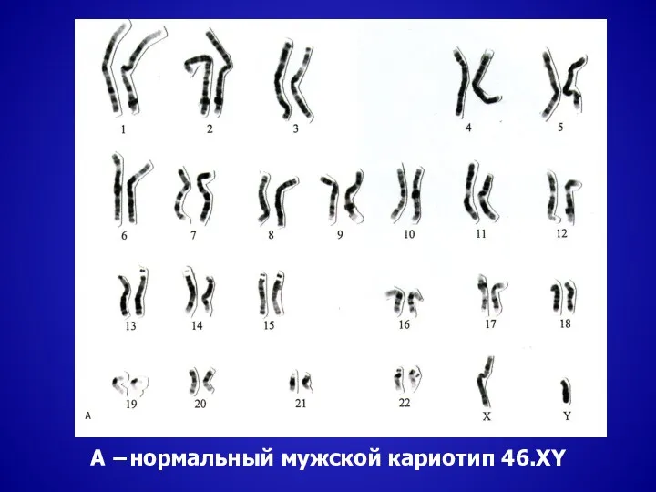 А −нормальный мужской кариотип 46.XY