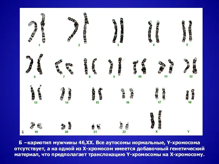 Б −кариотип мужчины 46,ХХ. Все аутосомы нормальные, Y-хромосома отсутствует, а