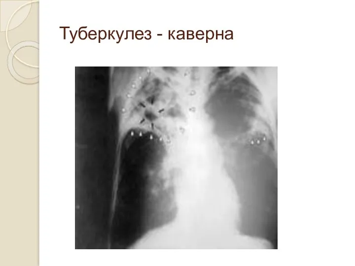 Туберкулез - каверна