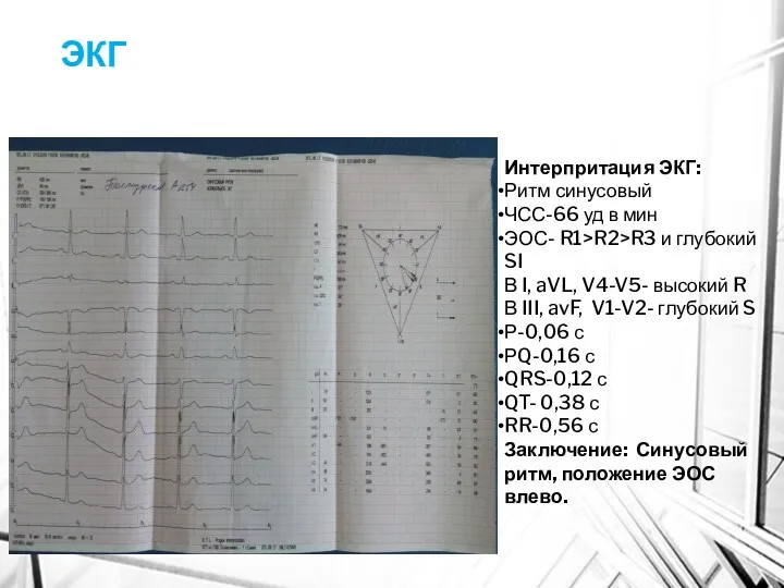 ЭКГ Интерпритация ЭКГ: Ритм синусовый ЧСС-66 уд в мин ЭОС-