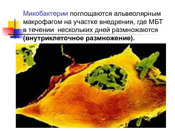 Микобактерии поглощаются альвеолярным макрофагом на участке внедрения, где МБТ в течении нескольких дней размножаются (внутриклеточное размножение).