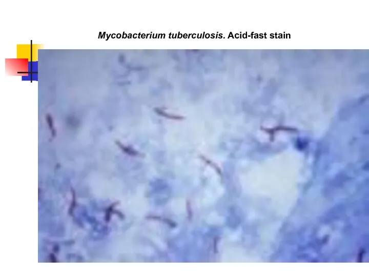 Mycobacterium tuberculosis. Acid-fast stain