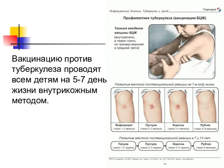 Вакцинацию против туберкулеза проводят всем детям на 5-7 день жизни внутрикожным методом.