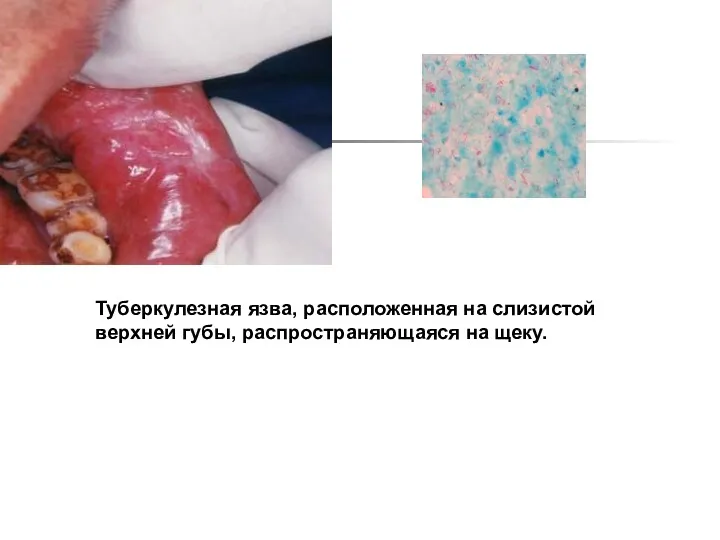 Туберкулезная язва, расположенная на слизистой верхней губы, распространяющаяся на щеку.