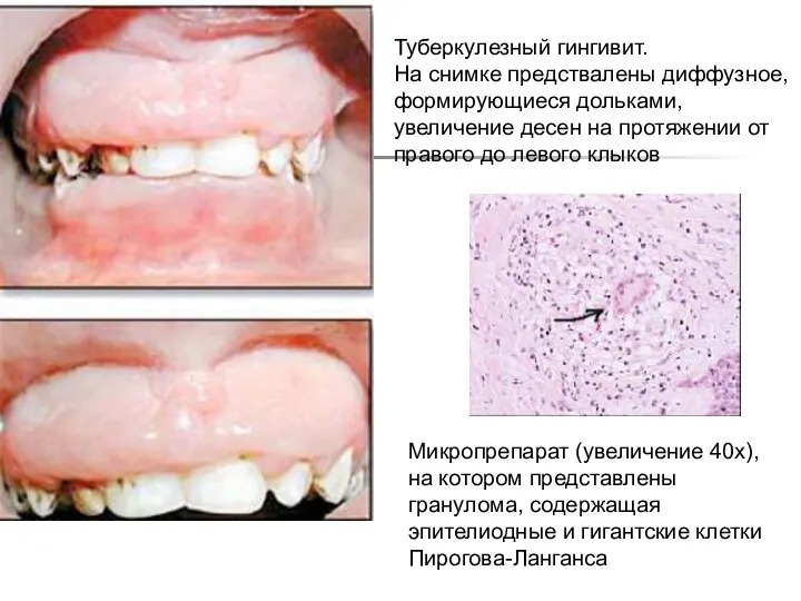 Туберкулезный гингивит. На снимке предствалены диффузное, формирующиеся дольками, увеличение десен