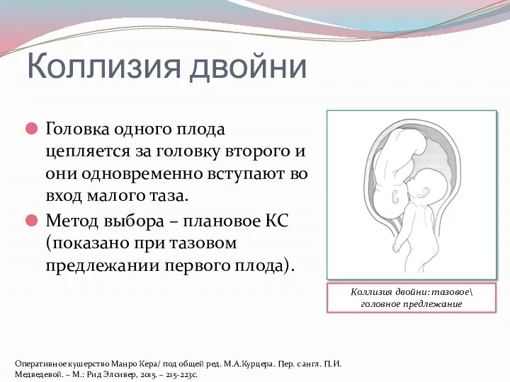 Коллизия двойни Головка одного плода цепляется за головку второго и они одновременно вступают