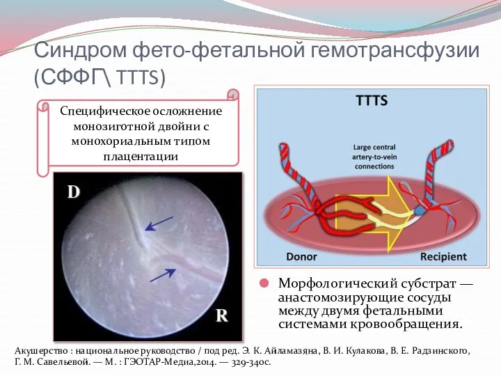 Синдром фето-фетальной гемотрансфузии (СФФГ\ TTTS) Морфологический субстрат — анастомозирующие сосуды между двумя фетальными