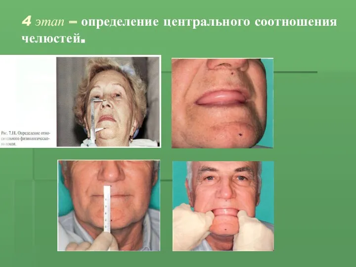 4 этап – определение центрального соотношения челюстей.